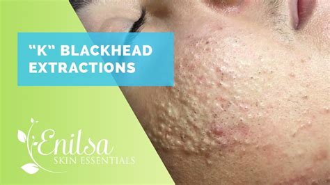 Oct 27, 2017 Enilsa Brownis aTexas-based aesthetician who posts videos of her acne treatment sessions on YouTube. . Enilsa brown youtube blackheads and large pores 2018